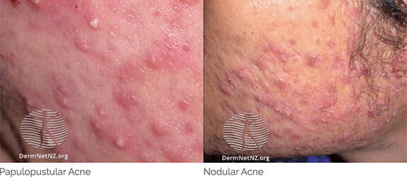 Acne Patient 3