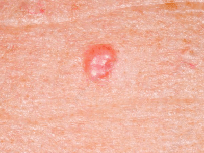 Example of Basal Cell Carcinoma