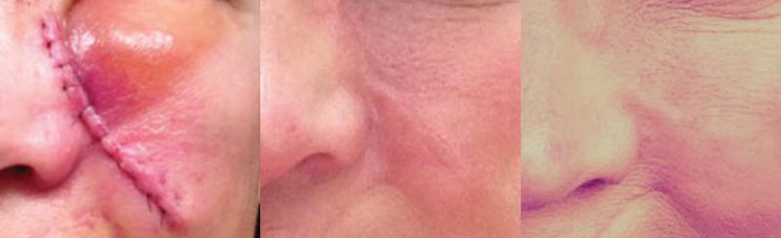 Facial Scar Case 2