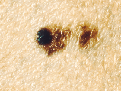 Example of Melanoma