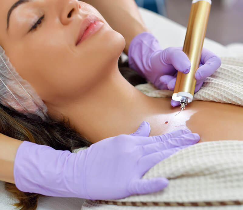 Woman getting a mole removed