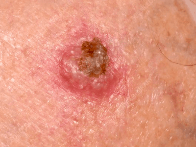 Squamous Cell Carcinoma