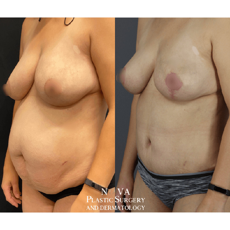 Actual tummy Tuck Patient Results