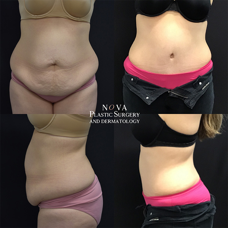 Tummy Tuck (Abdominoplasty) – DC Plastic Surgery Boutique