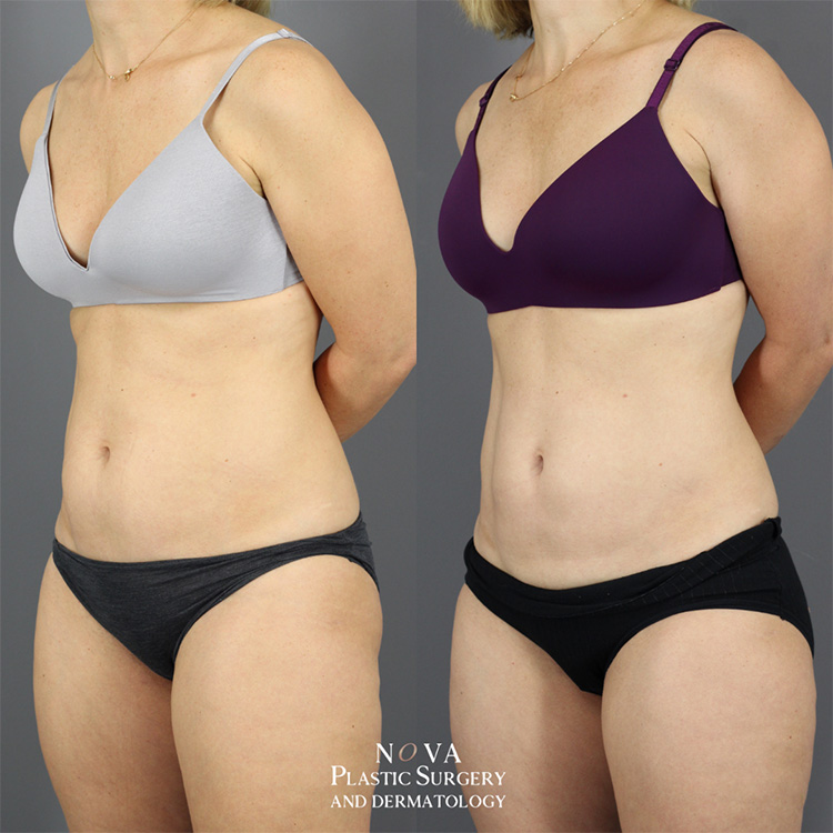 Liposuction, Ashburn, Northern Virginia