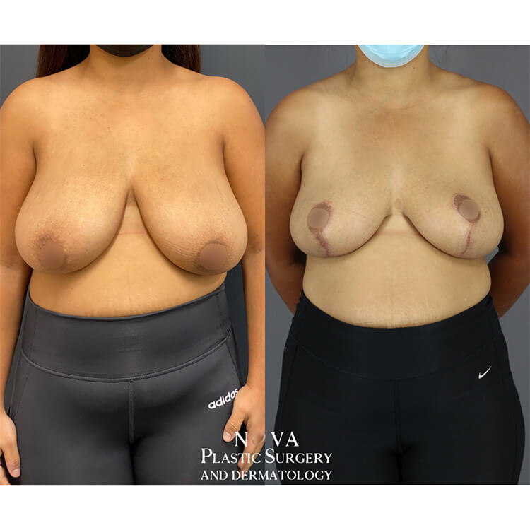 Breast Reduction Patient 01