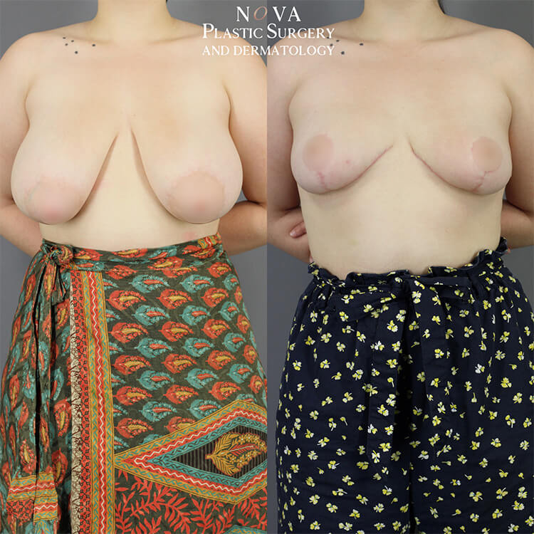 Breast Reduction Patient 02