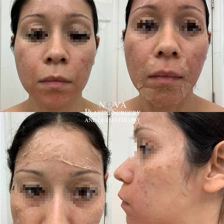 Chemical peels from a dermatologist