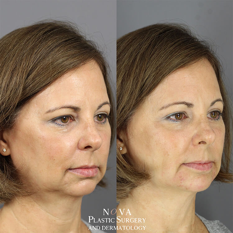 Cheek & Jawline Filler Patient 01