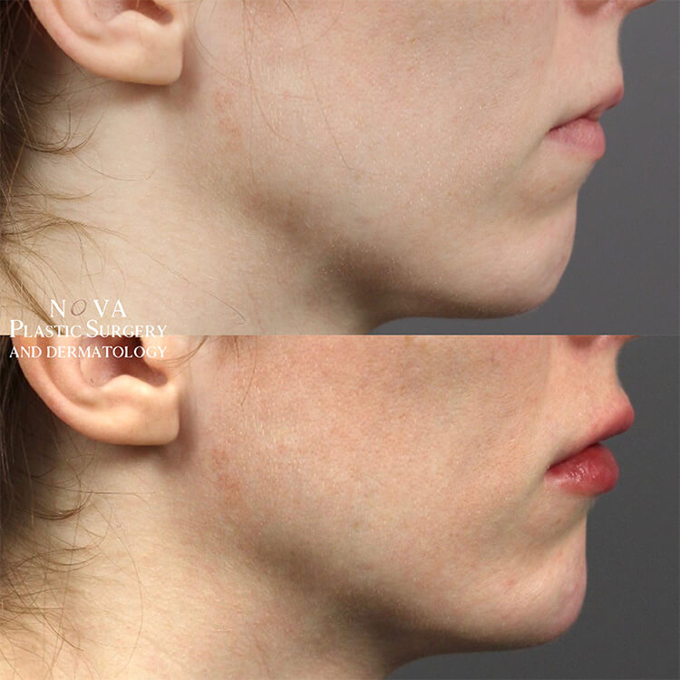 Cheek & Jawline Filler Patient 03