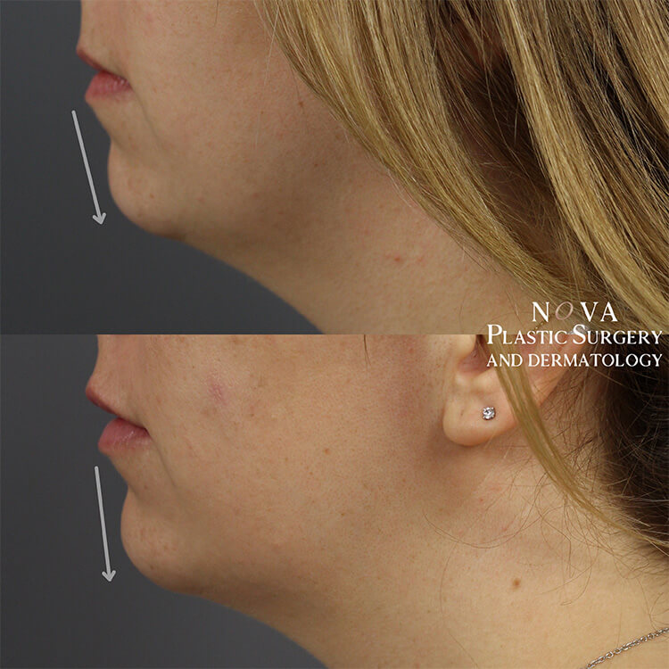 Chin fillers actual patient results