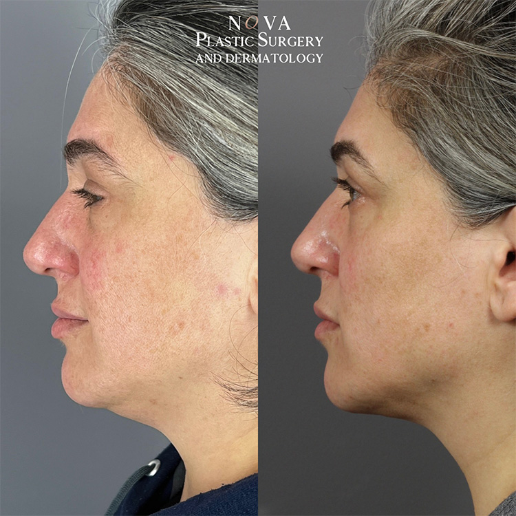 Chin Lipo Patient 01