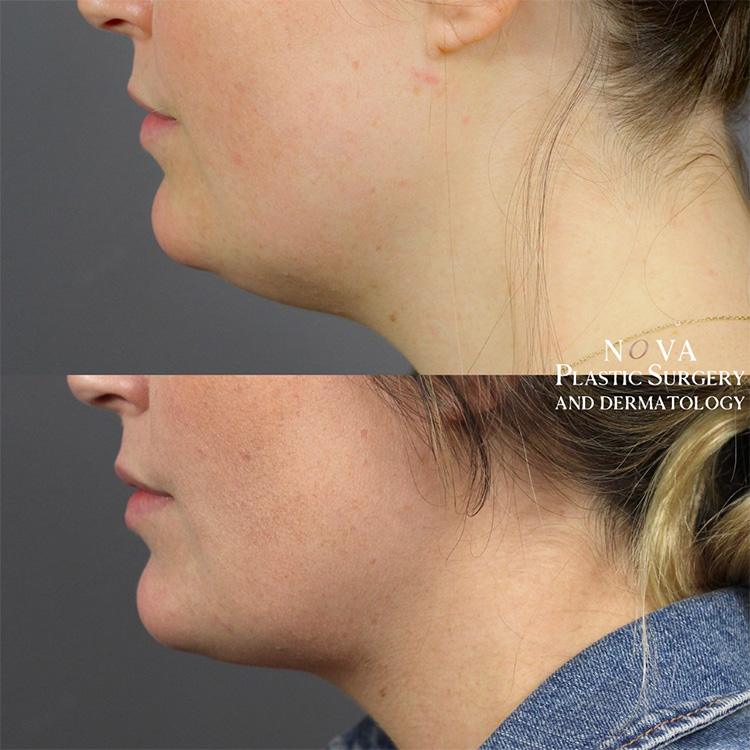 Chin Lipo Patient 02