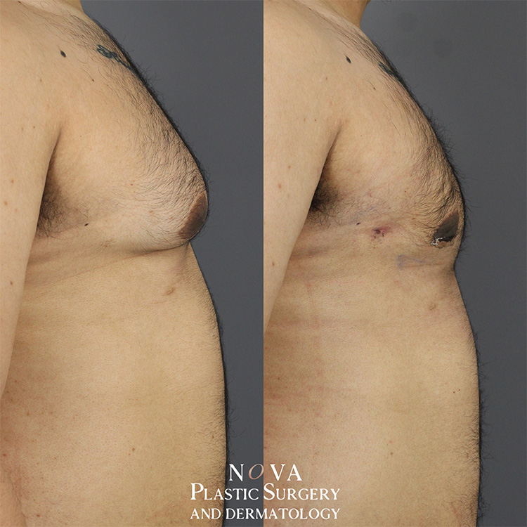 Gynecomastia Patient 01