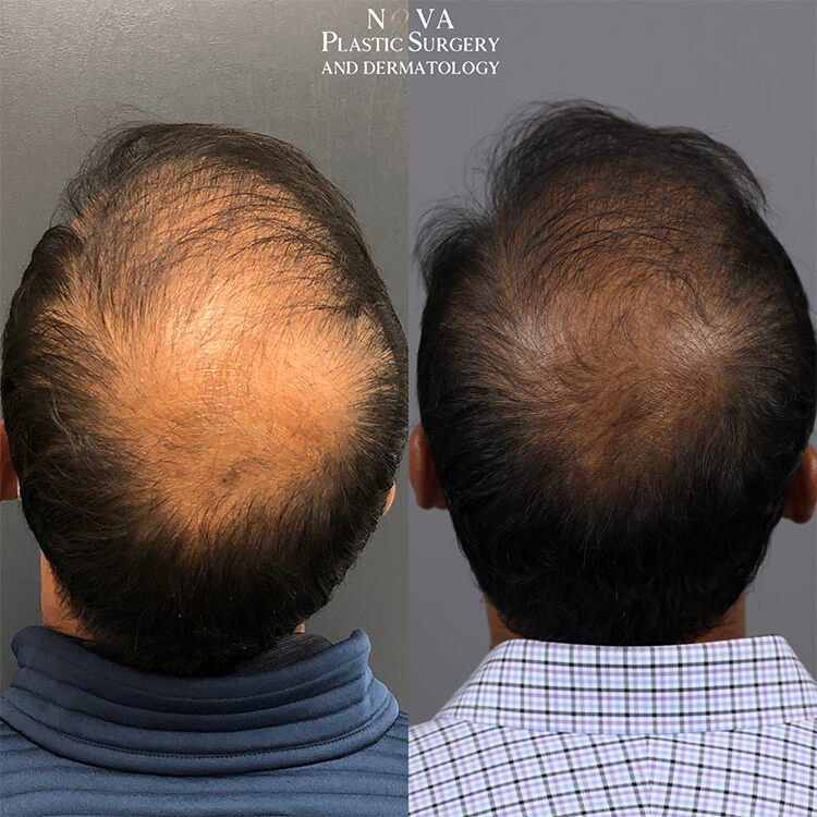 PRP Injections For Hair Loss and PRP Treatments in Northern VA