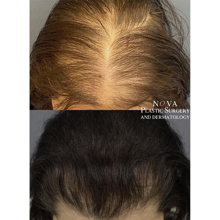 Hair Loss Patient 02