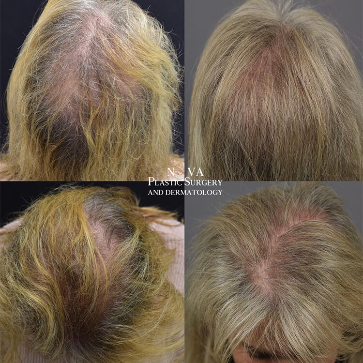 PRP Hair Treatment in Turkey - Cost and Procedure - Heva Clinic