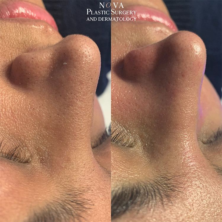 Hydrafacial Patient 02