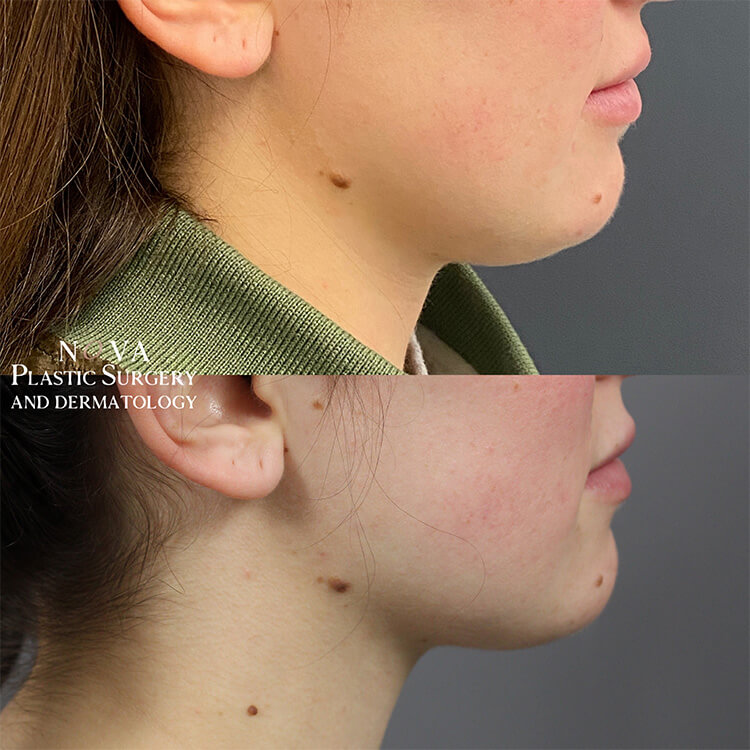 Kybella Patient 01