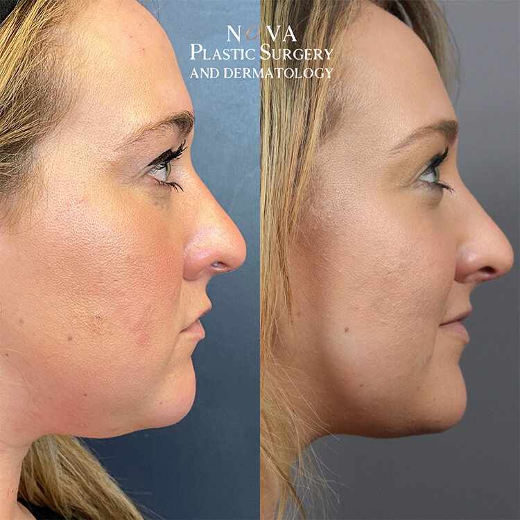 Kybella Patient 02