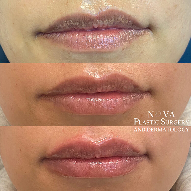 Lip Fillers Patient 01