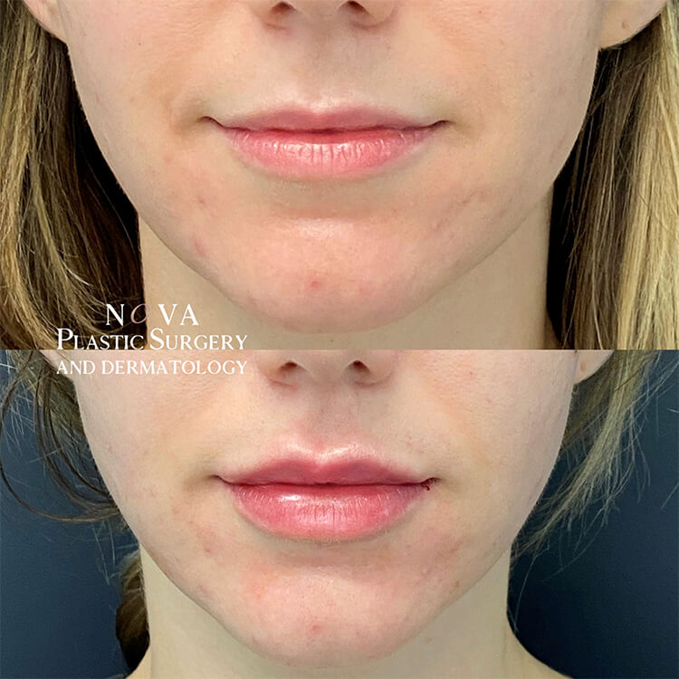 Lip Fillers Patient 02