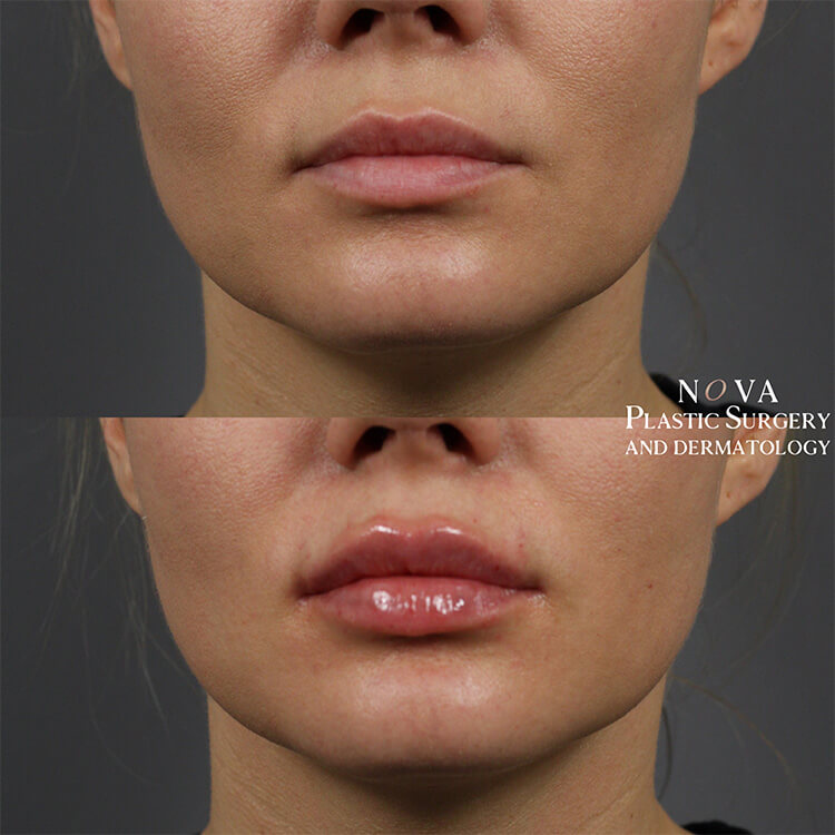 Lip Fillers Patient 05