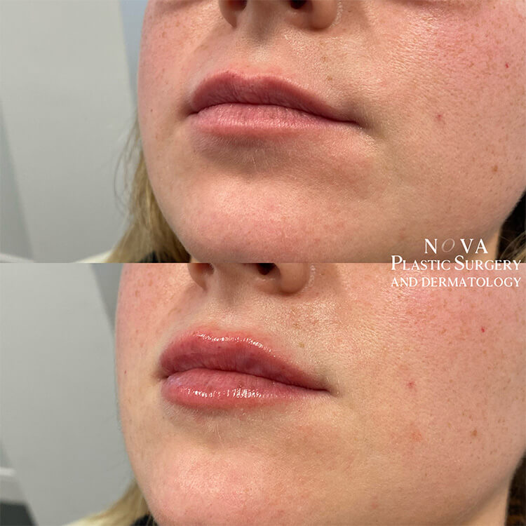 Lip Fillers Patient 06