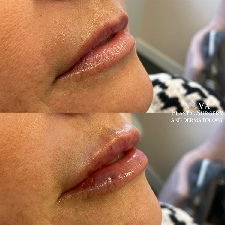 Lip Fillers Patient 07