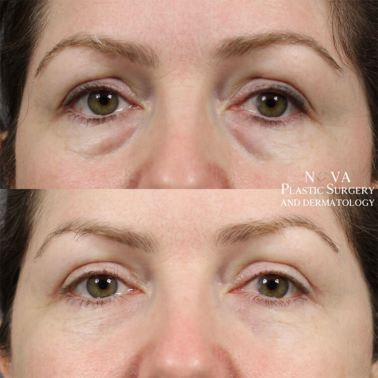 Lower Blepharoplasty Patient 01