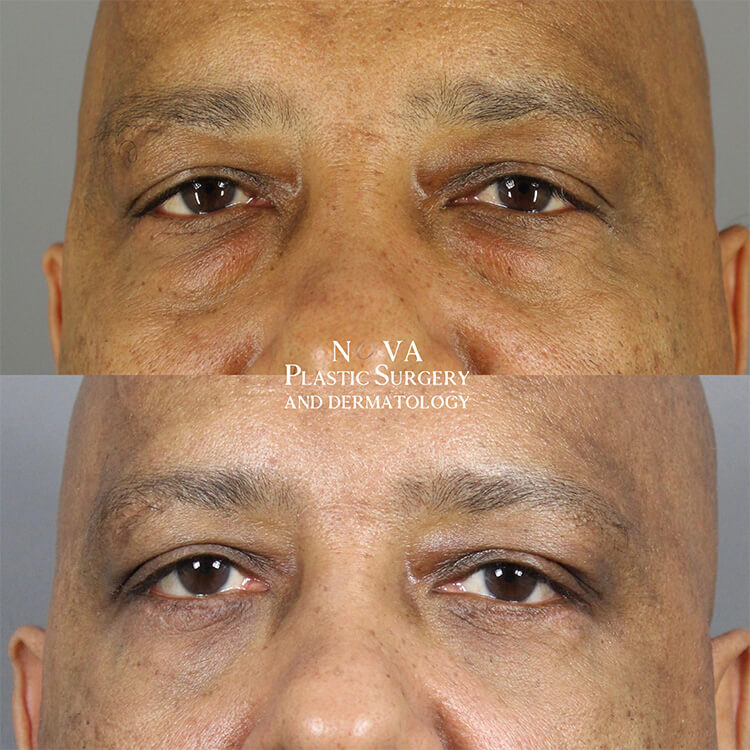 Lower Blepharoplasty Patient 02