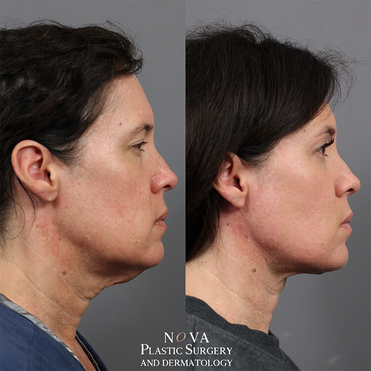 Before and after photos of a neck lift patient in Ashburn. VA