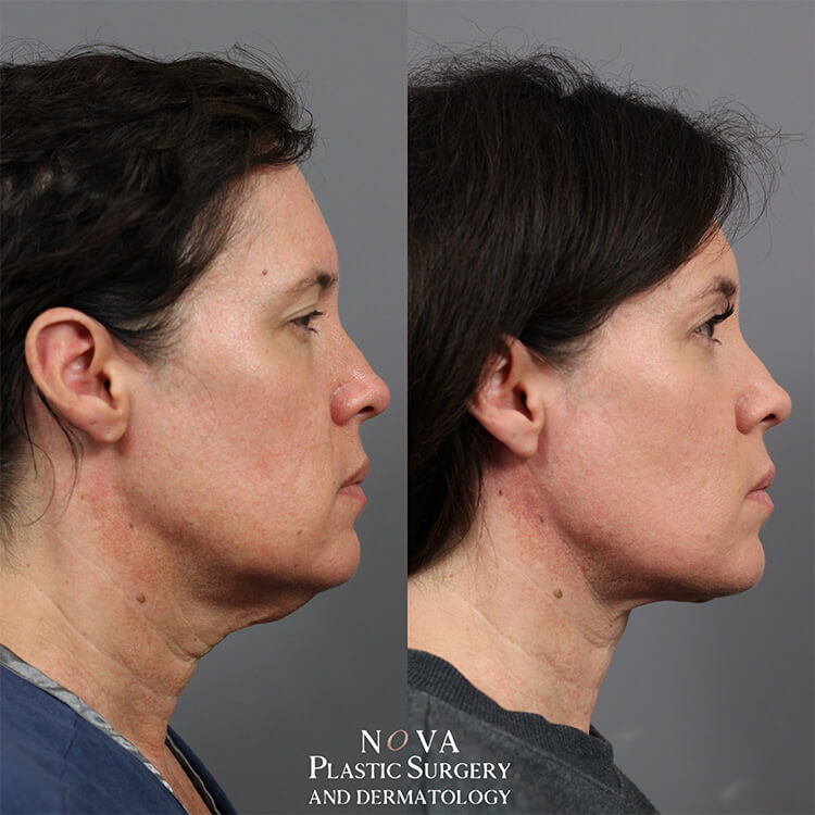 Neck Lift Patient 01