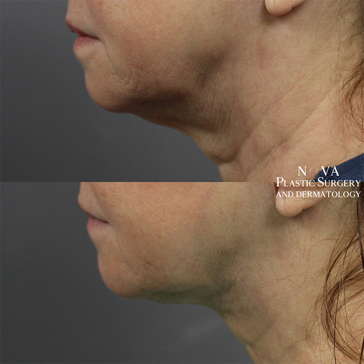 Neck Lift Patient 02