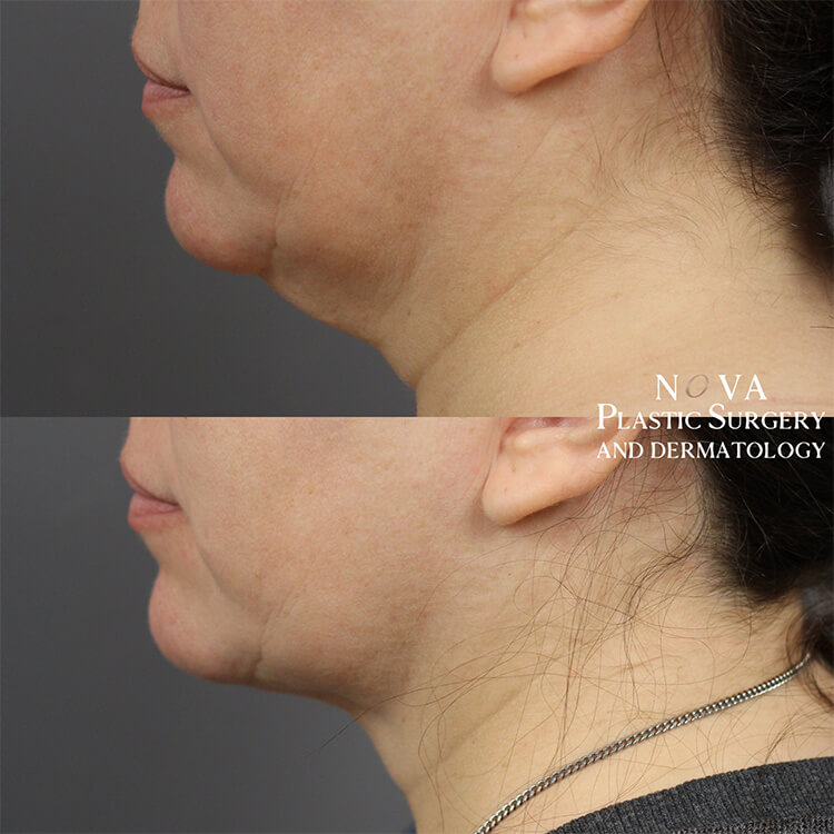 Neck Lift Patient 03