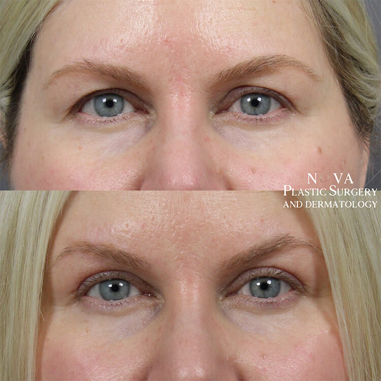 Upper Blepharoplasty Patient 01