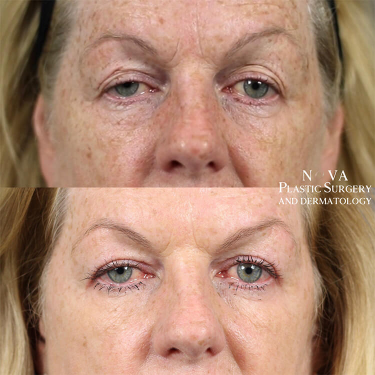 Upper Blepharoplasty Patient 02