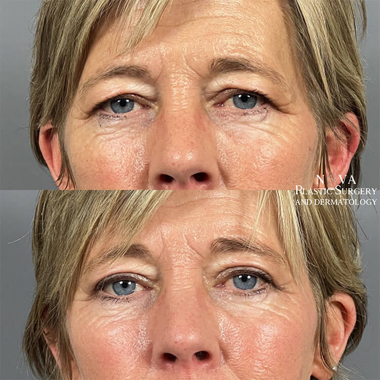 Upper Blepharoplasty Patient 03