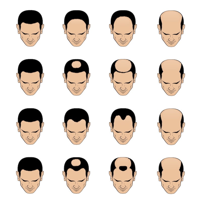 Types of male balding patterns.