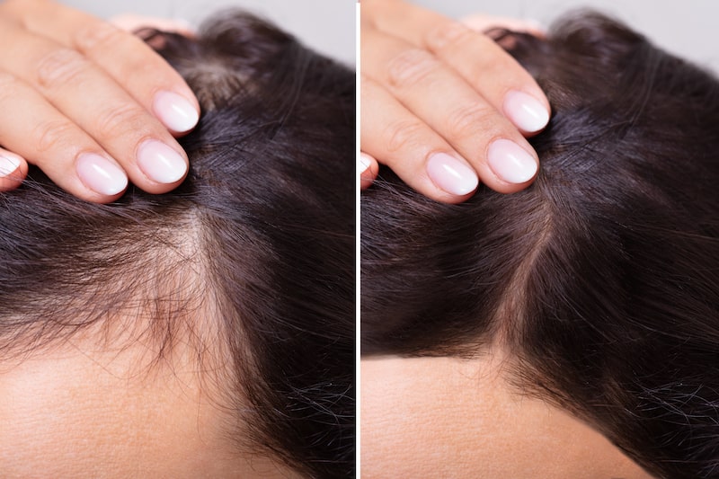 Scalp before and after hair loss treatment.
