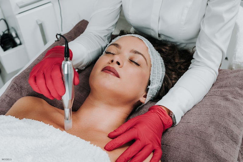 Treating the décolletage with microneedling.