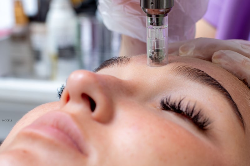 Woman receiving microneedling treatment.