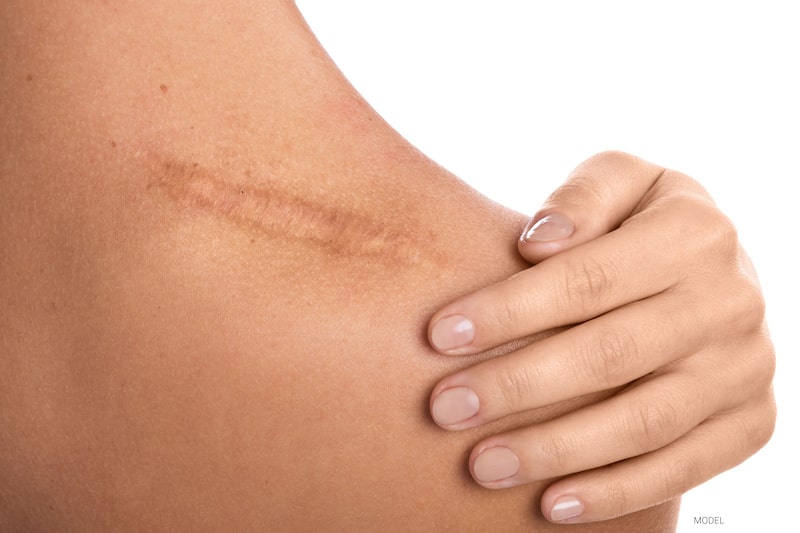 Close-up image of a scar on a woman's shoulder