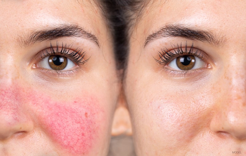 Before and after treatment photo of a woman's face with rosacea and skin redness