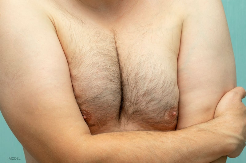 Close up of shirtless, middle-aged man with gynecomastia.