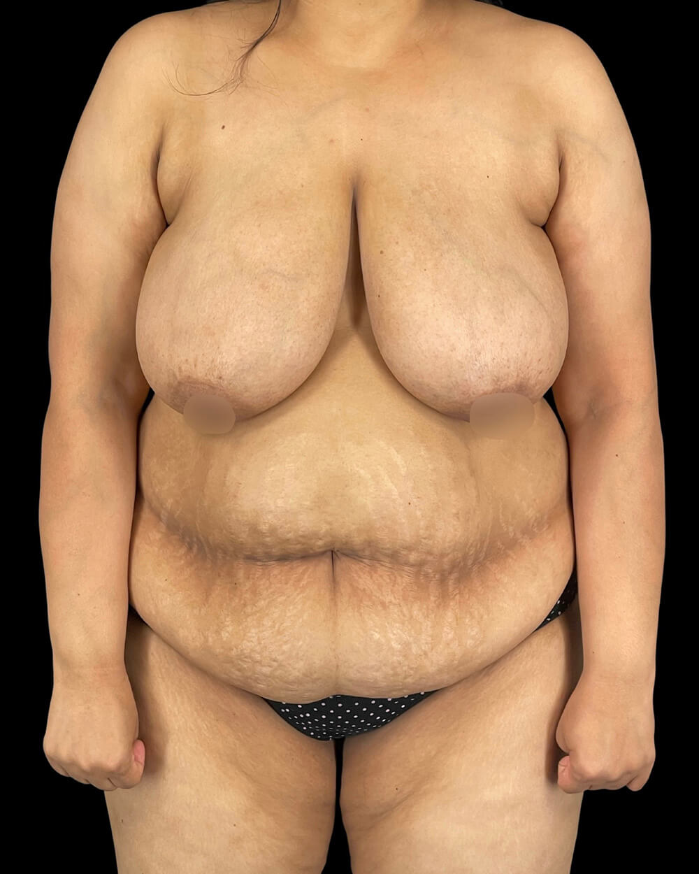 Case--7945 | Before Mommy Makeover