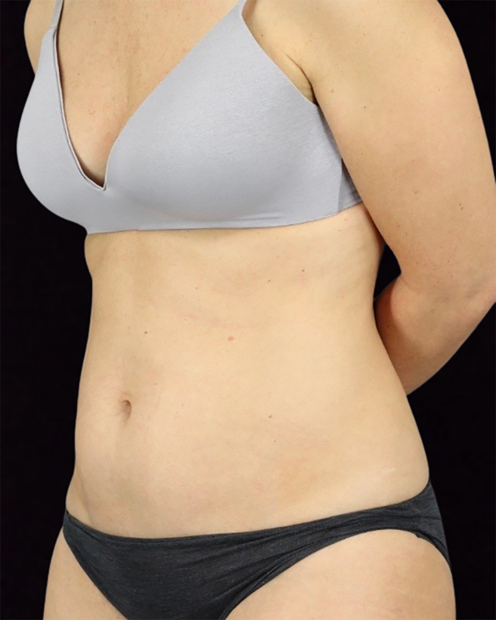 Case--2906 | Before Mommy Makeover