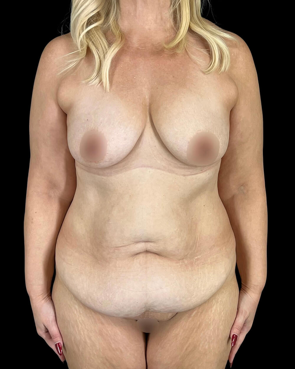 Case--2208 | Before Mommy Makeover