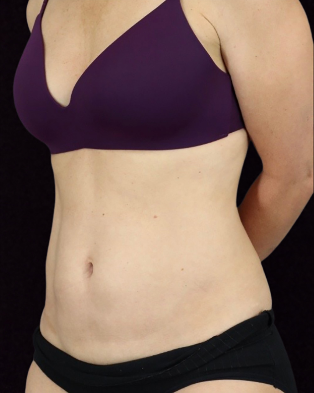 Case--2906 | After Mommy Makeover