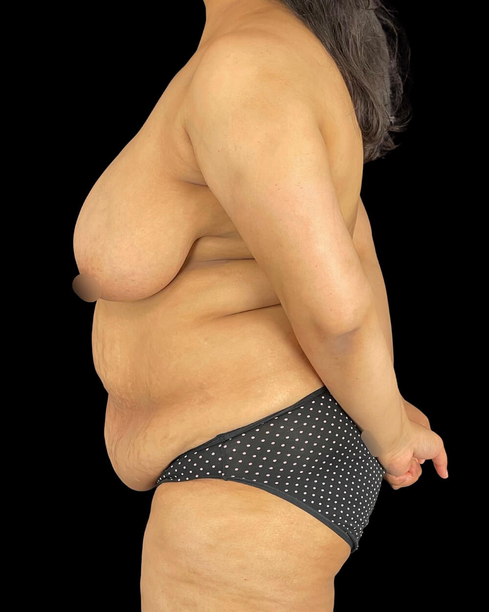 Case--7945 | Before Mommy Makeover 3